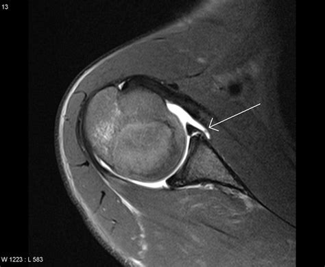 labral tear mri images